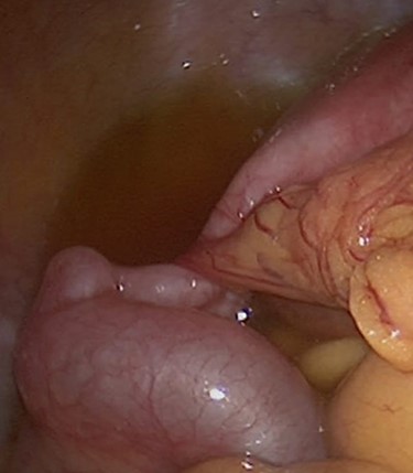 Colonoscopy showed no more adhesions.