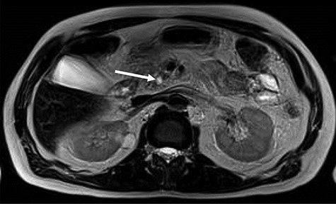 MRI—hyposignal focus within the main pancreatic duct in the cephalic region, measuring 0.6 cm, associated with irregular dilation of the upstream duct, suggesting stone (arrow).