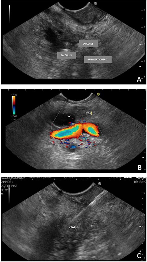 EUS—solid formation in the head/uncinate transition on its dorsal face. (A) EUS demonstrating multiple calculi and the pancreatic head; (B) EUS with evidence of a 7-mm Wirsung duct (PCR = pancreas; W=Wirsung duct). (C) Fine needle aspiration (FNA) of the nodular lesion.