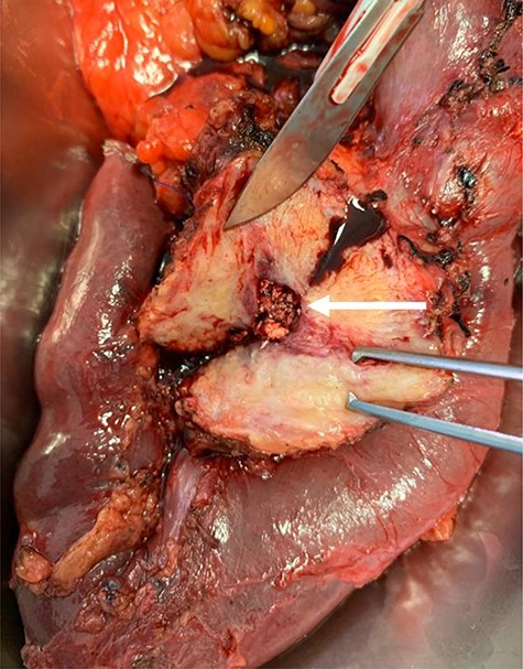 Surgical specimen demonstrating pancreatic ductal stones (arrow)