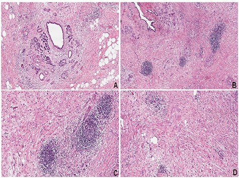 (A) CP with acinar atrophy, fibrosis and chronic inflammatory infiltrate (hematoxylin–eosin, HE). (B–D) Extensive areas of fibrosis with deposition of dense collagen. Presence of chronic inflammatory infiltrate with a predominance of lymphocytes and reactive lymphoid follicles (HE)