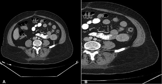 CT of the abdomen with Intravenous and oral contrast (axial section) shows: (A) 4 × 3.5 cm well-defined homogeneous extraluminal mass of proximal jejunum (white arrow) without intraperitonial metastasis or lymphadenomegaly; (B) mesenteric neovascularisation (white arrow).