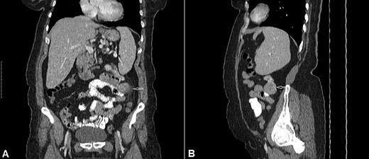 CT of the abdomen with Intravenous and oral contrast (A) coronal section, (B) sagittal section shows: well-defined extraluminal mass of proximal jejunum (white arrow).