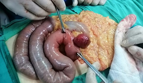 Intraoperative view: hypervascular 4 × 3.5 cm extraluminal mass of proximal jejunum. Small and large bowel are loaded with blood.