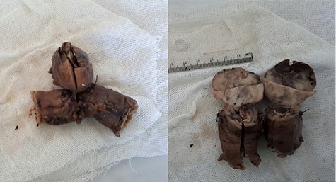Gross pathology: well-circumscribed extraluminal mass (4 × 3.5 × 3) cm; cut surface is smooth, tan and firm with lobulated appearance, hemorrhagic and necrotic areas.