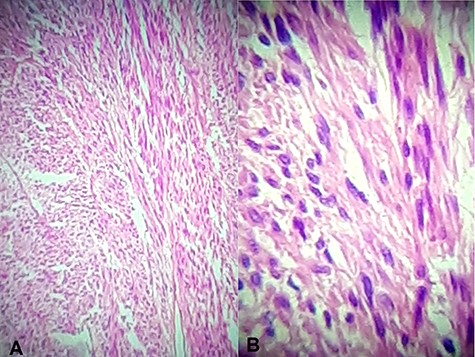 Hematoxylin and eosin stain (A) Jejunal mass at ×4 magnification, (B) jejunal mass at ×40 magnification: consist of spindle cells of varying cellularity, hyperchromatic and nuclear pleomorphism with areas of epithelioid cells (mixed type GIST).