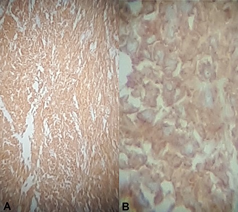 Immunohistochemical staining for CD117 (A) Jejunal mass at ×4 magnification, (B) jejunal mass at ×40 magnification is diffusely positive.