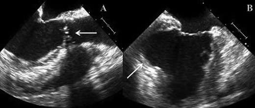 (A) TOE image showing bicuspid stenotic aortic valve. (B) TOE image demonstrating left ventricular apical aneurysm.