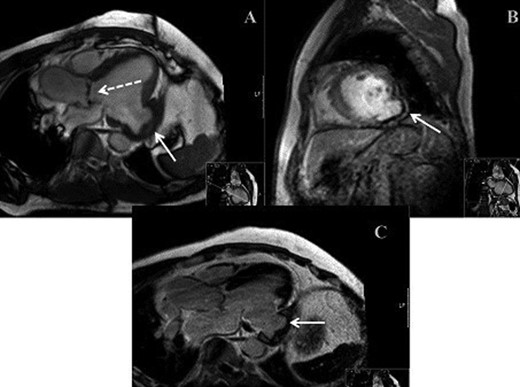 (A) MRI demonstrating bicuspid aortic valve (dashed arrow) and LVA (solid arrow). (B) MRI demonstrating parasagittal view of LVA. (C) MRI demonstrating mid-axial view of LVA.