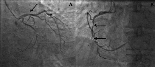 (A) Right anterior oblique (RAO) view demonstrating distal left anterior descending disease. (B) Left anterior oblique (LAO) view demonstrating mid right coronary artery disease.