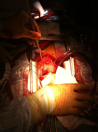 Intraoperative image demonstrating dissected LVA exposed and incised to perform intra-cavity thrombectomy.
