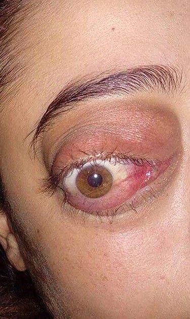 Severe chemosis and proptosis.