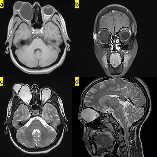 The transverse and coronal planes from MRI show hypointense hydatid cyst on T1-weighted images (a and b), whereas it appears hyperintense in the transverse and sagittal planes from MRI on T2-weighted images (c and d).