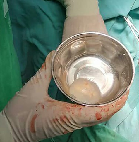 The large hydatid cyst was removed without rupture.