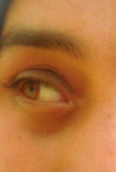 After the 3 months of follow-up, the proptosis and chemosis disappeared, and the eye movements returned to normal.