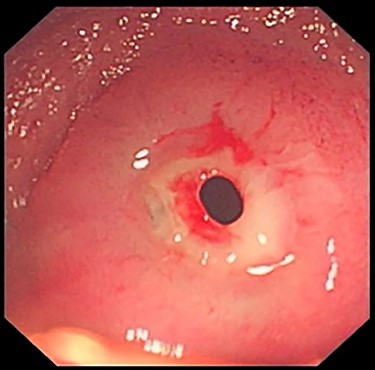 Capsule endoscopy showing an ileal diaphragm.
