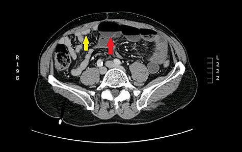Axial view: arrows pointing to dilated and collapsed small bowel.