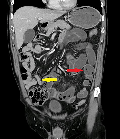 Coronal view: arrows pointing to dilated and collapsed small bowel.