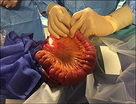 Peroperative enteroscopy.