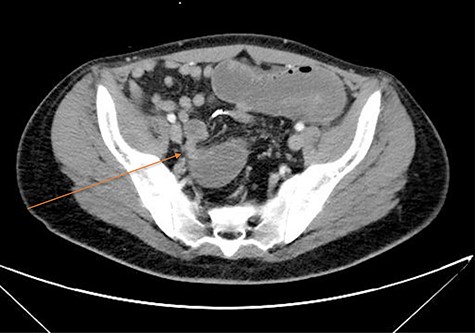 CT imaging demonstrating transition point in the pelvis at the level of the rectal stump; arrow marks transition point.
