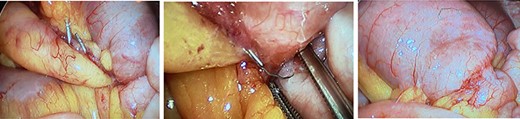 (A) Initial view of the transition point in the pelvis near the rectal stump; vascular clips are seen at the resection line. (B) View with careful exposure of the transition point demonstrating a free staple adherent to the rectal stump with one end and a loop of small bowel with the other. (C) Staple positioned on small bowel with transition point visible.