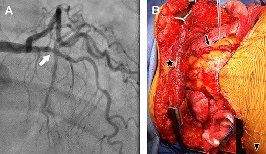 (A) Coronary angiogram showing a stenosis in the left anterior descending artery (arrow); (B) intraoperative photograph of the chest cavity via clamshell incision, showing the harvested LITA lying on the heart (arrow). Star marks the upper sternal edge; arrow head, the patient’s right side.