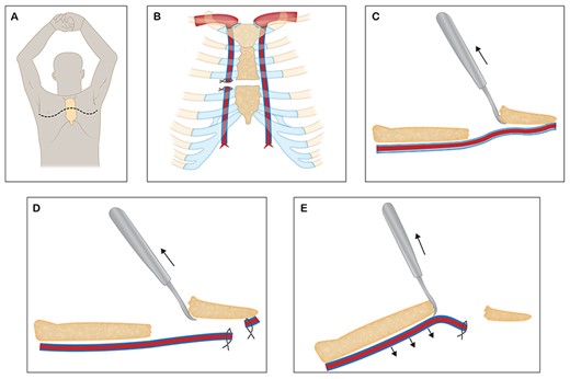 Sketches depicting the harvest of LITA via clamshell incision (A), ligation, division of the RITA and sternum (B), a bone hook was used to lift the lower sternal edge anteriorly and superiorly to expose the distal end of the LITA (C), which was harvested and divided (D), the proximal part of the LITA was harvested by elevating the superior sternal edge with a bone hook (E).