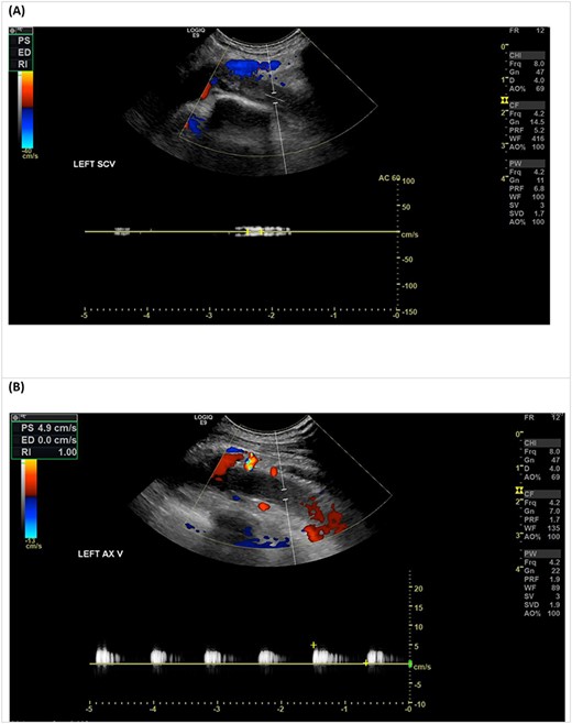 Venous duplex ultrasound of the LUL demonstrating an occlusive thrombus in the left subclavian vein (A), with sluggish flow in the axillary vein (B).