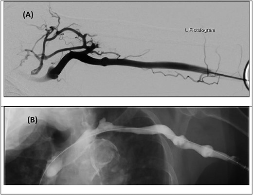 Digital subtraction venogram images prior to thrombectomy demonstrating occlusive thrombus at the proximal left subclavian vein/axillary vein confluence with numerous collateral vessels within the shoulder and axilla (A and B). (C) Post-thrombectomy venogram demonstrating improved flow with no further collateral vessels noted.