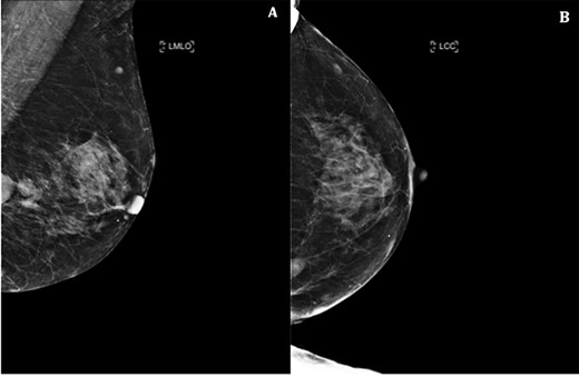 Left mammogram showing masses—A. Mediolateral oblique B. Cranial–caudal views.