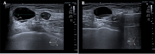 A. Left breast ultrasound showing two lesions at the 9 o’clock position measuring a total distance of 37 mm. B. Core biopsy done of the main lesion.