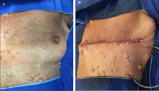 Photograph showing multiple neurofibroma in patient with NF-1 A. Pre- and B. Post-left mastectomy and sentinel lymph node biopsy.
