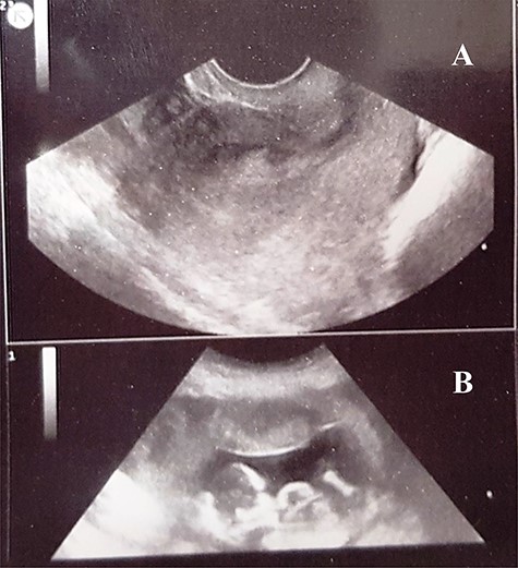 A 2D pelvic ultrasound scan showing a normal size uterus, with thick endometrium (A), peritoneal fluid, and an abdominally aborted gestational sac containing a dead embryo (B) mimicking a ruptured ectopic pregnancy.