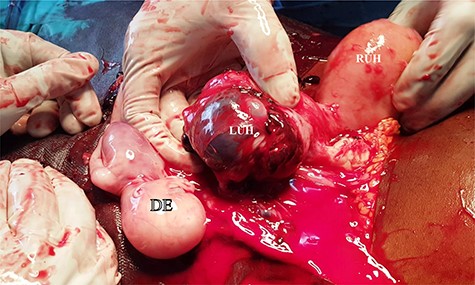 Intra-operative findings; hemoperitoneum, a bicornate uterus with a left non-communicating ruptured corporeal atrophic rudimentay uterine horn (LUH), a dead embryo (DE), an intact right uterine horn of normal size.