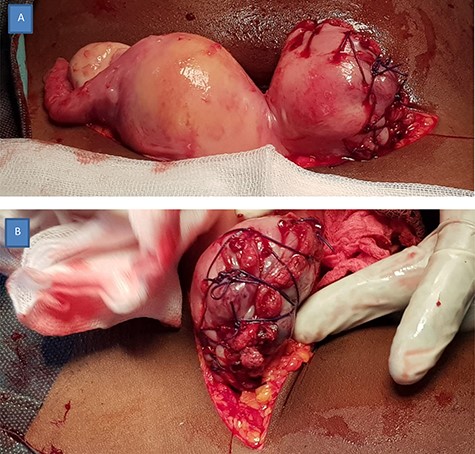 Hysterorraphy at the level of left uterine horn corpus. Frontal view (A), and lateral view (B).