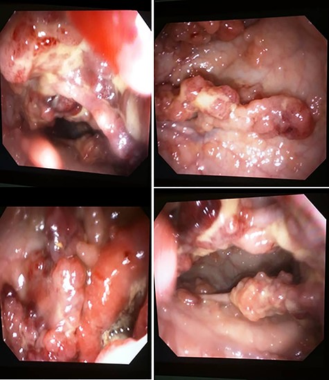 Colonoscopy view of the large bowel.
