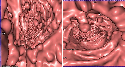 Photomicrographs of large bowel showing polypoid lesions (H and E, x40).