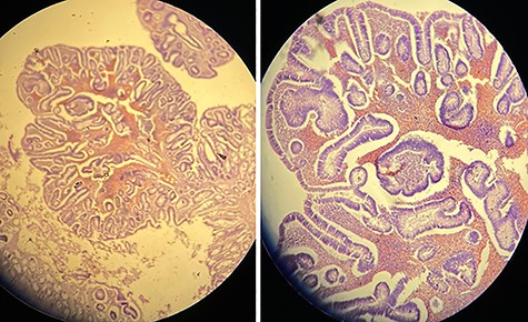 CT virtual colonoscopy view of the large bowel.