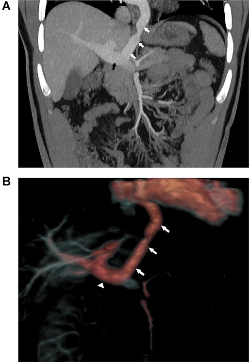 (A) Coronal view of abdominal CT with contrast demonstrating the large vessel (white arrows) between LA and portal vein (black arrow). (B) 3D reconstruction of CT with contrast demonstrating the large vessel (arrows) between LA and portal vein (triangle).
