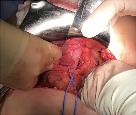 Intra-abdominal exposure of the infra-diaphragmatic portion of the vessel following ligation of a small left lateral tributary.