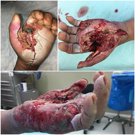 Progression of the case through subsequent procedures. Necrosis of the skin, superficial and deep fascia, expanding necrosis of the left thenar eminence and medial side of the hand. Dorsal and medial views of the hand after the second and third debridements undertaken are presented as well. A horseshoe abscess furthered necrosis throughout the hand.