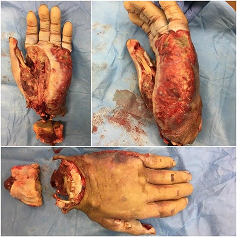 Photographs of hand immediately after the distal forearm procedure. Necrosis spread through an infected horseshoe from the thenar space to the ulnar side/hypothenar eminence of the hand. Ventral, medial and dorsal views of the hand are presented.