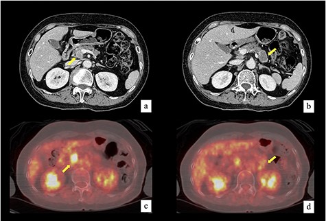 Contrast-enhanced computed tomography revealed an 18-mm mass in the pancreatic head that had invaded the right side of SMV (a) and a 32-mm mass in the pancreatic tail (b). FDG positron emission tomography showed the accumulation of FDG in both masses. The maximum standardized uptake value was 12.9 in the pancreatic head mass (c) and 3.0 in the pancreatic tail mass (d).