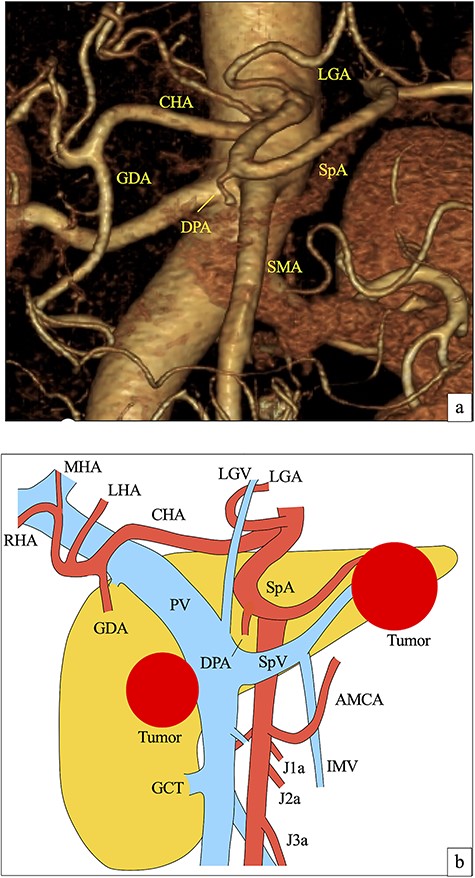 (a) Preoperative 3D computed tomography angiographic image from an anteroposterior view. The DPA branched from the root of the SpA. (b) Preoperative illustration of vessels around pancreas and pancreatic tumors. LGA, left gastric artery; CHA, common hepatic artery; GDA, gastroduodenal artery; LHA, left hepatic artery; MHA, middle hepatic artery; RHA, right hepatic artery; SMA, superior mesenteric artery; AMCA, accessory middle colic artery; J1a, first jejunum artery; J2a, second jejunum artery; J3a, third jejunum artery; LGV, left gastric vein; PV, portal vein; IMV, inferior mesenteric vein; GCT, gastrocolic trunk.