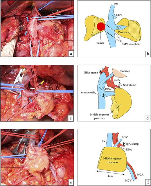 (a) On laparotomy, the pancreatic head tumor had invaded the right wall of the SMV (blue arrows). Distal pancreatectomy was performed. (b) Illustration of (a). The SMV was resected diagonally to preserve the SpV. (c) After reconstruction of the SMV (blue arrows). The SpV was preserved. The white arrow shows the preserved DPA (taped), and yellow arrow shows the stump of the SpA. (d) Illustration of (c). (e) The middle segment of the pancreas was preserved. The length of the remnant pancreas was about 4 cm. (f) Illustration of (e). MCA, middle colic artery; MCV, middle colic vein.