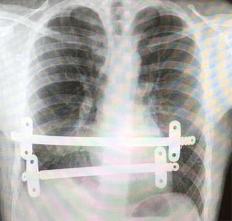 Postoperative chest X-ray following initial Nuss procedure, showing both substernal bars inserted to elevate the depression caused by pectus excavatum.