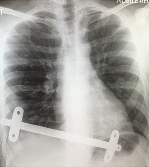 Chest X-ray taken after the removal of the upper substernal bar. The second bar is seen, traversing the diaphragm, having migrated into the stomach.