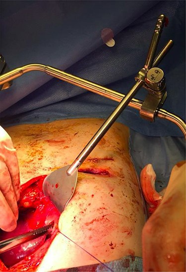 Superior lateral intraoperative view of the laparotomy used to access and remove the second migrated bar.