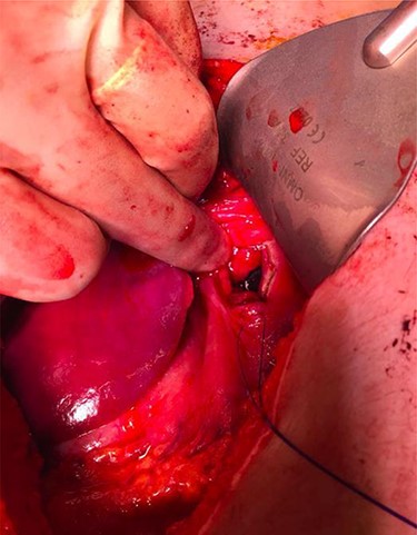Superior intraoperative view of the laparotomy used to access and remove the second migrated bar.