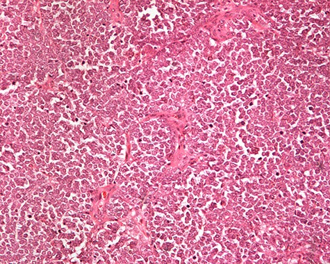 Monotonous round cells with a scant cytoplasmic rim, round vesicular nuclei, apoptotic bodies and mitoses ×20 H&E.